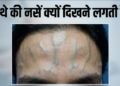 Forehead की उभरी नसों और तनाव के बीच गहरा संबंध: विशेषज्ञों की राय