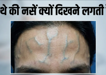 Forehead की उभरी नसों और तनाव के बीच गहरा संबंध: विशेषज्ञों की राय