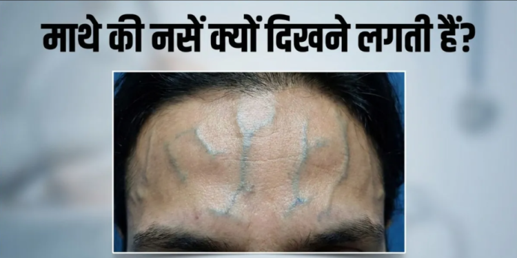 Forehead की उभरी नसों और तनाव के बीच गहरा संबंध: विशेषज्ञों की राय