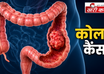 कोलन कैंसर (Colon Cancer): शुरुआती लक्षण, कारण और बचाव के तरीके