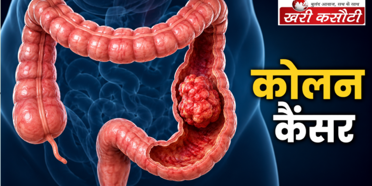 कोलन कैंसर (Colon Cancer): शुरुआती लक्षण, कारण और बचाव के तरीके