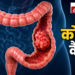 कोलन कैंसर (Colon Cancer): शुरुआती लक्षण, कारण और बचाव के तरीके